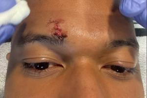 给姆总整破相了！姆巴佩晒脸部受伤近距离特写，眉骨缝了好几针